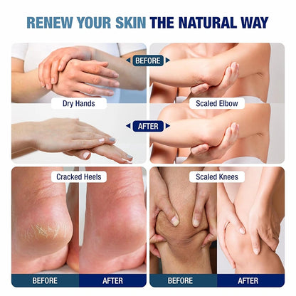 Lunaris 20% Urea Foot Cream Roll On - 50ml | For Dry, Cracked Or Calloused Foot Skin Repair | With 2% Lactic Acid, Olive Oil & Vitamin E | Helps Moisturise & Exfoliates Dead Skin | Non Greasy